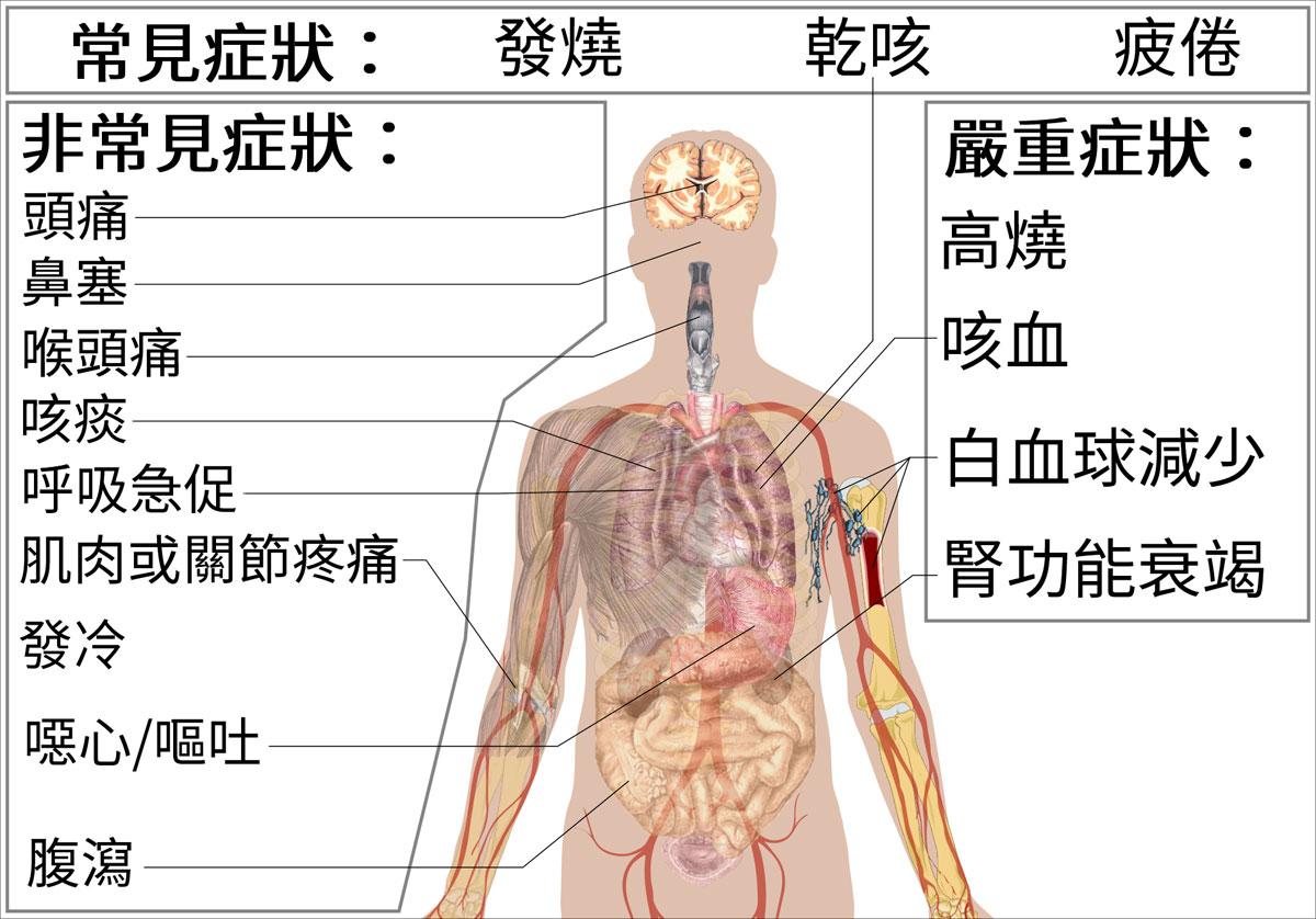 Symptoms of coronavirus disease 2019 2 - Völlig absurd - China, Corona-Pandemie, Medien - Blog